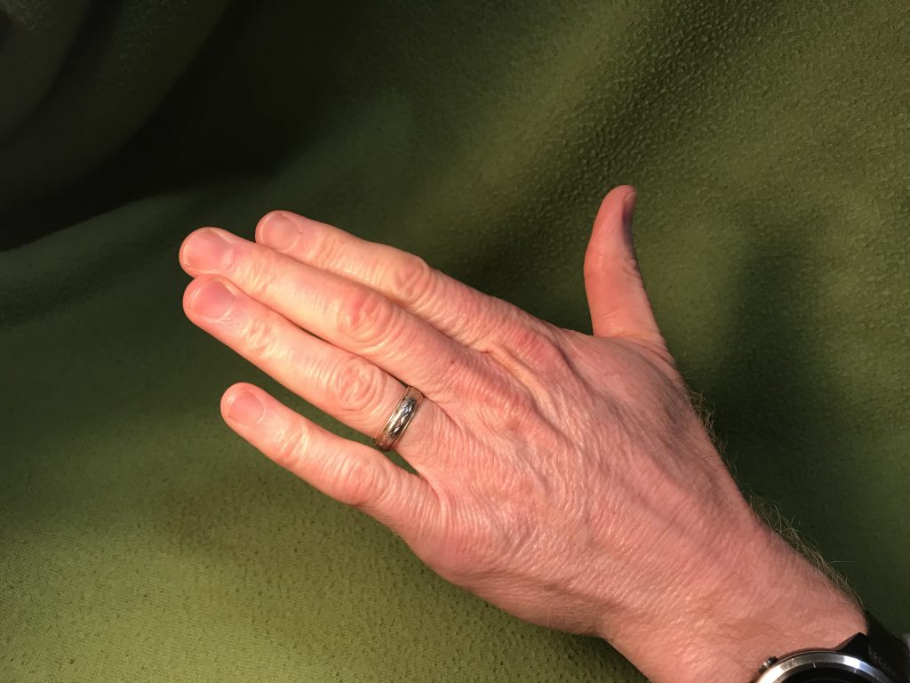 Relaxed fingers and finger tendon gliding positions. (A) Relaxed, (B)